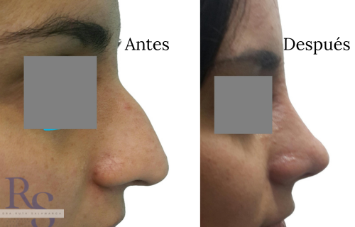 Rinoplastia doctora ruth salamanca cirujana plastica turismo medico estético bogota colombia