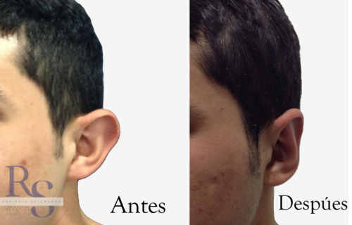 La cirugía de orejas u otoplastia