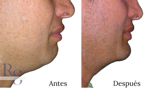 Aumento de mentón o mentoplastia