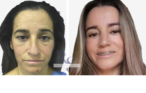 El Lifting o Estiramiento facial Dra ruth Myriam Salamanca cirujana plástica estético bogota colombia