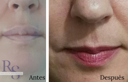 El aumento de labios facial Dra ruth Myriam Salamanca cirujana plástica estético bogota colombia